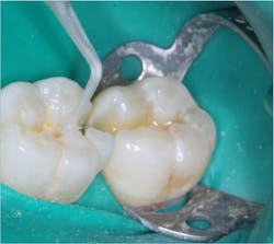 Figure 4: Tooth prep desensitization is essential if the prep is vital. Disinfection is essential on both vital and nonvital teeth with two one-minute applications of MicroPrime, Gluma, G5, etc., which is provided by the glutaraldehyde materials (5% glutaraldehyde and 35% HEMA).