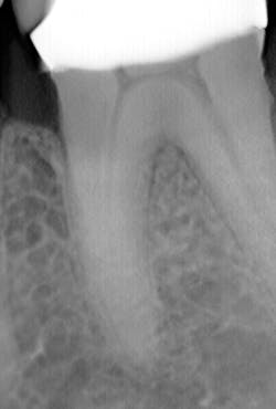 Figure 4: 2D showing internal resorption Figure 4: 2D showing internal resorption
