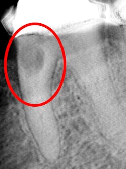 Figure 5: 3D tomosynthesis showing internal resorption Figure 5: 3D tomosynthesis showing internal resorption