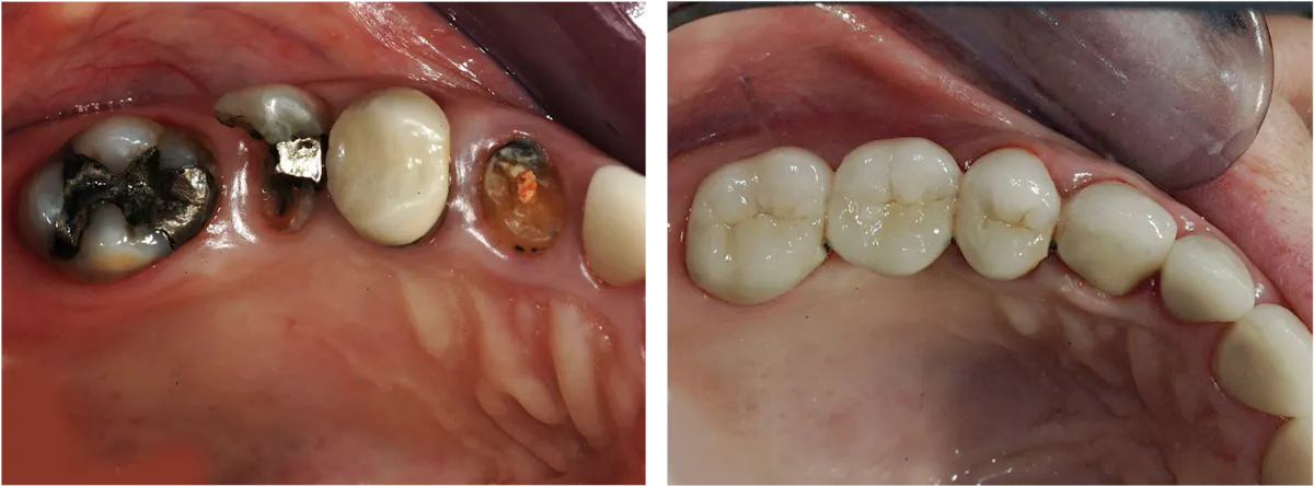 Why should teeth be removed? | Dental Economics