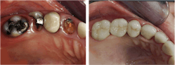 Figure 6: Using the techniques in this article, the built-up teeth (right) have been serving in the mouth for 17 years. The second premolar (left) was extracted before the restorations were completed.