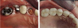 Figure 6: Using the techniques in this article, the built-up teeth (right) have been serving in the mouth for 17 years. The second premolar (left) was extracted before the restorations were completed. Figure 6: Using the techniques in this article, the built-up teeth (right) have been serving in the mouth for 17 years. The second premolar (left) was extracted before the restorations were completed.