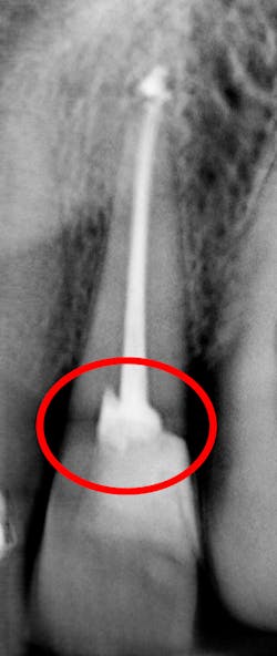 Figure 7: 3D tomosynthesis showing a horizontal fracture Figure 7: 3D tomosynthesis showing a horizontal fracture