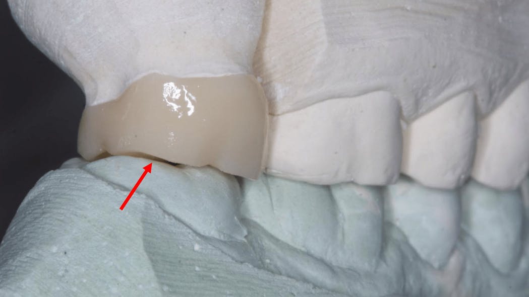 Figure 1: Some laboratories are significantly spacing crowns so that they do not touch opposing teeth. Several weeks or more of tooth extrusion are required to achieve occlusal contact. This also creates increased forces on the adjacent teeth.