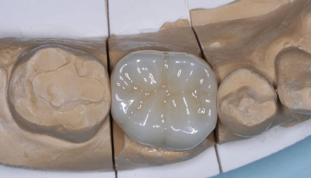 Solving zirconia occlusion challenges Dental Economics