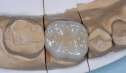 Figure 2: Occlusal anatomy on zirconia crowns is based on a library in the cloud and may or may not match the anatomy of the surrounding teeth.
