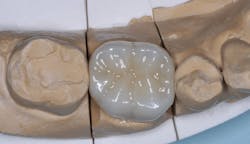 Figure 2: Occlusal anatomy on zirconia crowns is based on a library in the cloud and may or may not match the anatomy of the surrounding teeth. Figure 2: Occlusal anatomy on zirconia crowns is based on a library in the cloud and may or may not match the anatomy of the surrounding teeth.