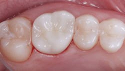 Figure 3: Color mismatch has been a problem from the initiation of zirconia into the dental profession. Most labs place a thin layer of low-fusing color on the zirconia crown externally to approximate the desired color. Figure 3: Color mismatch has been a problem from the initiation of zirconia into the dental profession. Most labs place a thin layer of low-fusing color on the zirconia crown externally to approximate the desired color.