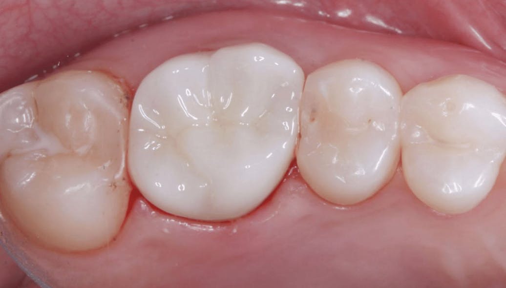 Figure 3: Color mismatch has been a problem from the initiation of zirconia into the dental profession. Most labs place a thin layer of low-fusing color on the zirconia crown externally to approximate the desired color.