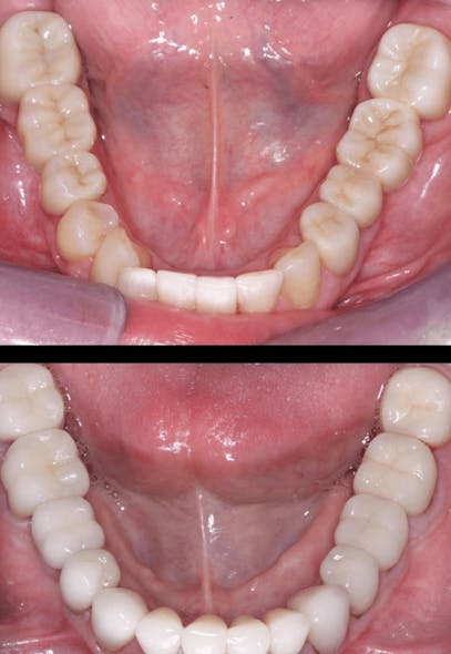 Figure 4: The top image is one of the first 3Y zirconia cases placed nine years ago with externally placed glaze and stain on the surface, which has a finite lfe and eventually dissolves and wears off.