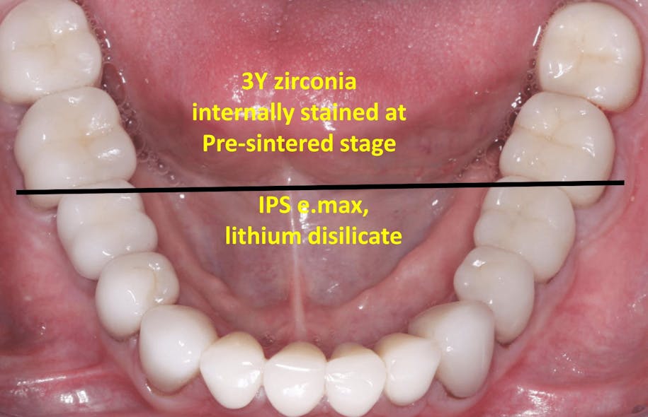 Figure 5: This patient received internally stained 3Y zirconia at the presintered stage on the molars and lithium disilicate on the remainder of the teeth. I doubt you can tell the difference. There is no stain or glaze on any of the crowns. Both 3Y zirconia and lithium disilicate wear like enamel. Glaze wears opposing tooth structure of some restorative materials (Clinicians Report Foundation TRAC in vivo research).
