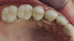 built-up-teeth-restorative-dentistry