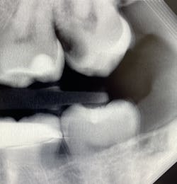 Figure 9: 3D tomosynthesis showing caries on tooth no. 15 Figure 9: 3D tomosynthesis showing caries on tooth no. 15
