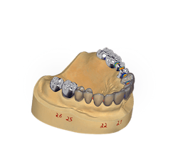 2. ChairsideCAD (Exocad) 2. ChairsideCAD (Exocad)