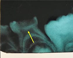 Figure 2. Radiograph shows tertiary dentin formation after treatment of caries lesion with 38% SDF. Shoreview Dental LLC. Figure 2. Radiograph shows tertiary dentin formation after treatment of caries lesion with 38% SDF. Shoreview Dental LLC.