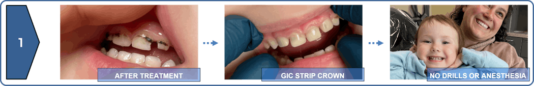 Figure 3: Images showing caries lesions after treatment with 38% SDF (left) followed by those same lesions after a GIC strip crown is applied (center), and the patient and parent smiling. Shoreview Dental LLC.