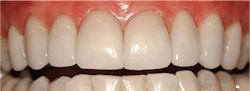Figure 1: These veneers have successfully served for 17 years cemented over acid-etched enamel. If the veneers need to be removed for any reason, they would have to be cut off. They have mechanical retention. Figure 1: These veneers have successfully served for 17 years cemented over acid-etched enamel. If the veneers need to be removed for any reason, they would have to be cut off. They have mechanical retention.