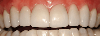 Figure 1: These veneers have successfully served for 17 years cemented over acid-etched enamel. If the veneers need to be removed for any reason, they would have to be cut off. They have mechanical retention.