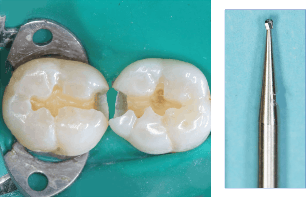 Obtaining optimum retention for tooth restorations | Dental Economics