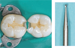 Figure 3: Most proximal box forms need mechanical retention provided by a small bur—not just a bonding agent. Figure 3: Most proximal box forms need mechanical retention provided by a small bur—not just a bonding agent.