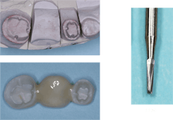 Figure 4: Short nonretentive preps often require parallel grooves on most of the axial walls. This fixed prosthesis is 3Y milled zirconia. Don&rsquo;t let your lab technician eliminate the grooves in the crown.