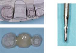 Figure 4: Short nonretentive preps often require parallel grooves on most of the axial walls. This fixed prosthesis is 3Y milled zirconia. Don’t let your lab technician eliminate the grooves in the crown. Figure 4: Short nonretentive preps often require parallel grooves on most of the axial walls. This fixed prosthesis is 3Y milled zirconia. Don’t let your lab technician eliminate the grooves in the crown.