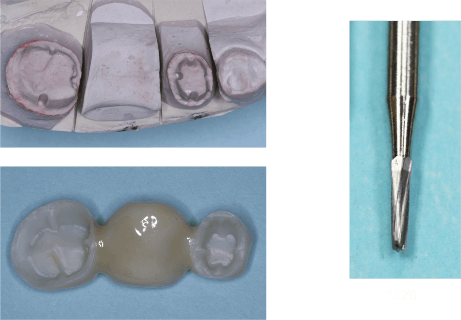 Figure 4: Short nonretentive preps often require parallel grooves on most of the axial walls. This fixed prosthesis is 3Y milled zirconia. Don&rsquo;t let your lab technician eliminate the grooves in the crown.