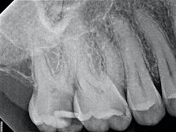 Figure 1: From top to bottom: preop IO, bitewing, and periapical x-ray Figure 1: From top to bottom: preop IO, bitewing, and periapical x-ray