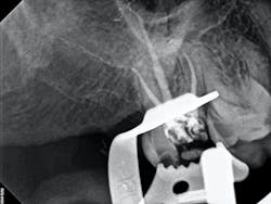 Figure 2: From top to bottom: scanned prep, endo with RD Figure 2: From top to bottom: scanned prep, endo with RD