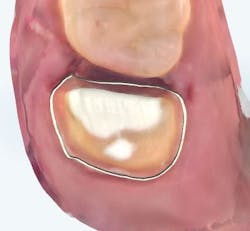Figure 3: Scanned prep with margin marked Figure 3: Scanned prep with margin marked