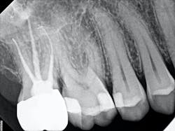 Figure 4: From top to bottom: Crown delivery bitewing after fillings, crown delivery bitewing before fillings, final periapical x-ray Figure 4: From top to bottom: Crown delivery bitewing after fillings, crown delivery bitewing before fillings, final periapical x-ray