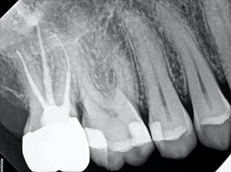 Figure 4: From top to bottom: Crown delivery bitewing after fillings, crown delivery bitewing before fillings, final periapical x-ray