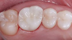 zirconia-color-mismatch zirconia-color-mismatch