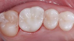 658205bec3b145001ea1d32c Figure3colormismatchzirconiadentalcrowns 658205bec3b145001ea1d32c Figure3colormismatchzirconiadentalcrowns