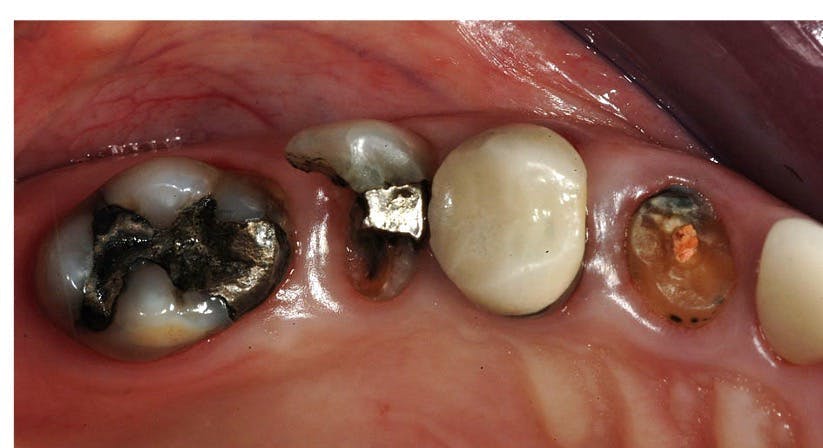 Figure 1: Typical restorative need observed routinely. These teeth need significant building up for long-term service.
