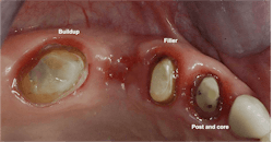 Figure 2: A buildup in the molar, removal of the second premolar, a small filler in the occlusal of the remaining premolar, and a post and core with pins in the canine.