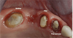 Figure 2: A buildup in the molar, removal of the second premolar, a small filler in the occlusal of the remaining premolar, and a post and core with pins in the canine. Figure 2: A buildup in the molar, removal of the second premolar, a small filler in the occlusal of the remaining premolar, and a post and core with pins in the canine.