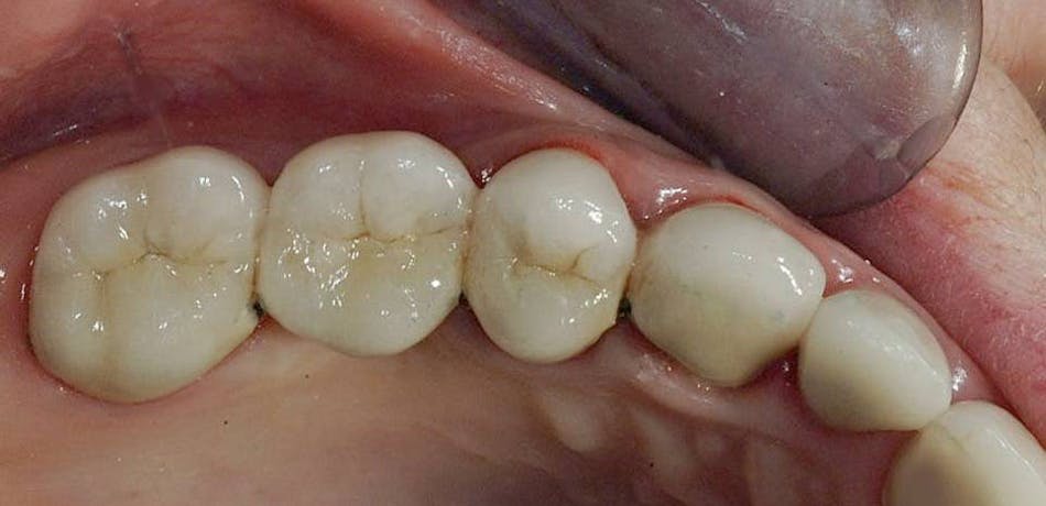 Figure 3: These finished restorations have served for many years.