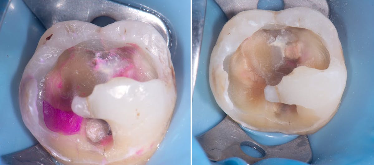 Figure 2: Caries-disclosing solution is used to perform selective caries removal. The image on the right shows that the total structure of healthy tooth remained after caries clean-out.