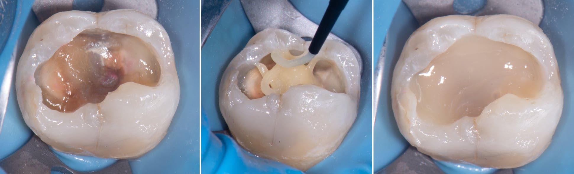 Exploring the transformative mechanical and esthetic properties of ...