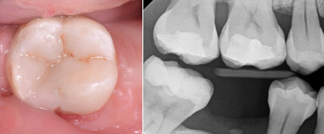 Figure 5: Three years&rsquo; follow-up of the restoration. The patient plans to go through implant placement.