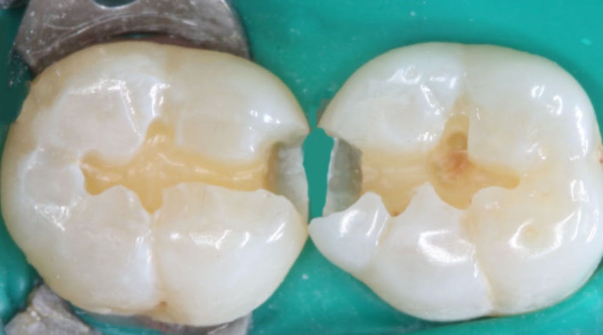 optimum-retention-dental-restorations