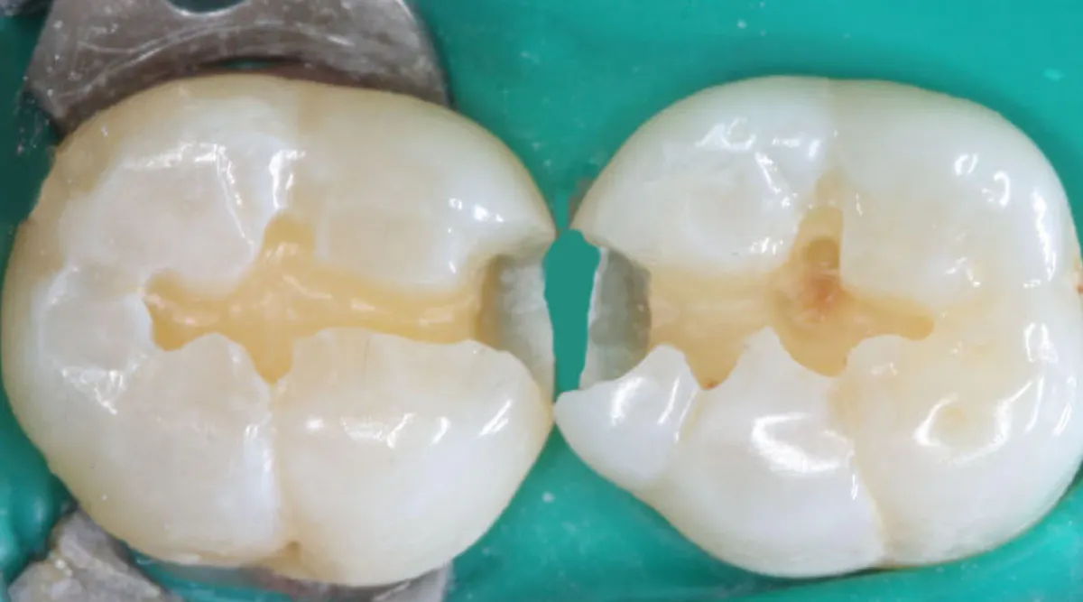 Tooth Retention Obtaining optimum retention for tooth restorations | Dental Economics