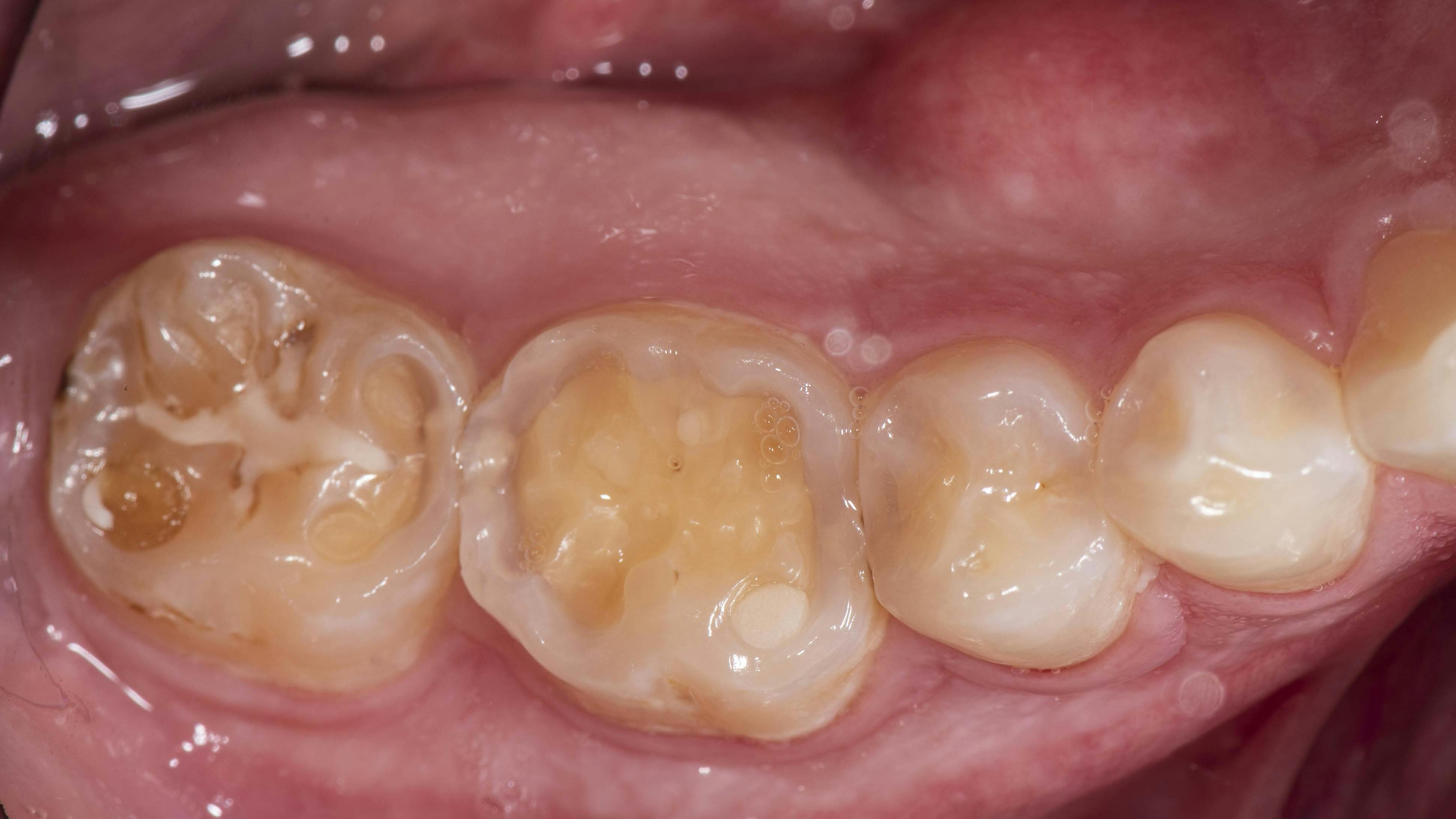 Figure 1: Initial presentation. Note the exposed dentin due to erosion.