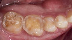 Figure 1: Initial presentation. Note the exposed dentin due to erosion. Figure 1: Initial presentation. Note the exposed dentin due to erosion.