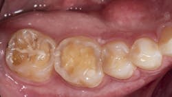 Figure 1: Initial presentation. Note the exposed dentin due to erosion. Figure 1: Initial presentation. Note the exposed dentin due to erosion.