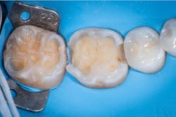 Figure 3: Tooth preparation. Note the decalcification on the adjacent teeth. Figure 3: Tooth preparation. Note the decalcification on the adjacent teeth.