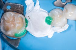 Figure 4: Resin infiltration. This procedure was carried out using ICON (DMG), followed by the placement of a flowable composite and polishing with composite polishing discs. Figure 4: Resin infiltration. This procedure was carried out using ICON (DMG), followed by the placement of a flowable composite and polishing with composite polishing discs.