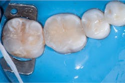 Figure 5: Final restorations Figure 5: Final restorations