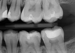 Figure 7a: Pre-op radiograph and clinical photo Figure 7a: Pre-op radiograph and clinical photo